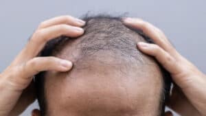 ماهو أفضل مركز لزراعة الشعر في تركيا