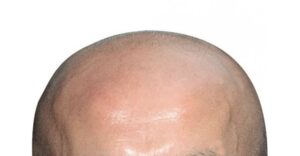 زراعة الشعر بالشريحة FUT