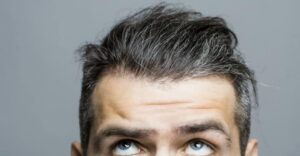 زراعة الشعر بدون حلاقة