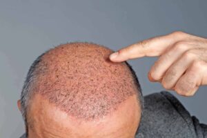 مراحل عملية زراعة الشعر