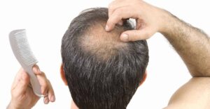 عملية زراعة الشعر