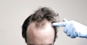 زراعة الشعر في مقدمة الرأس