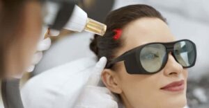 زراعة الشعر بالليزر