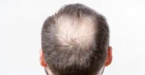 قبل زراعة الشعر في تركيا
